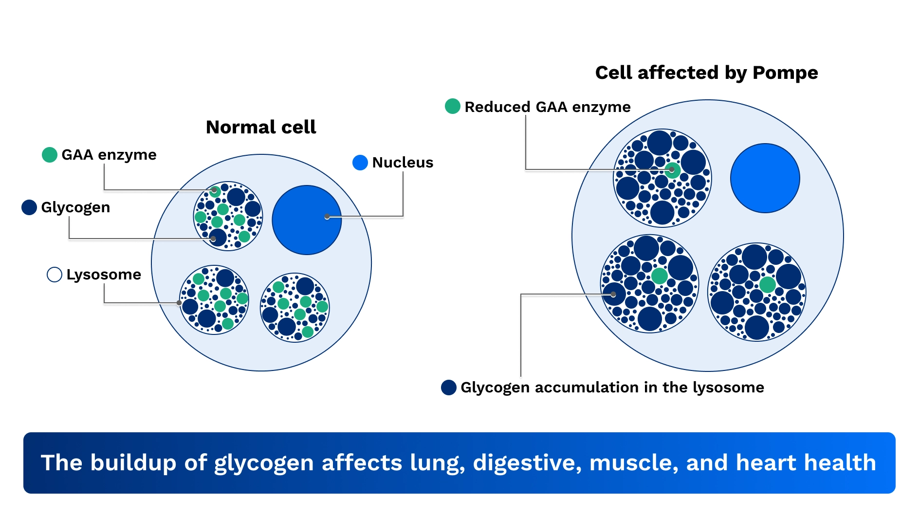 A diagram showing normal cell and cell affected by Pompe disease