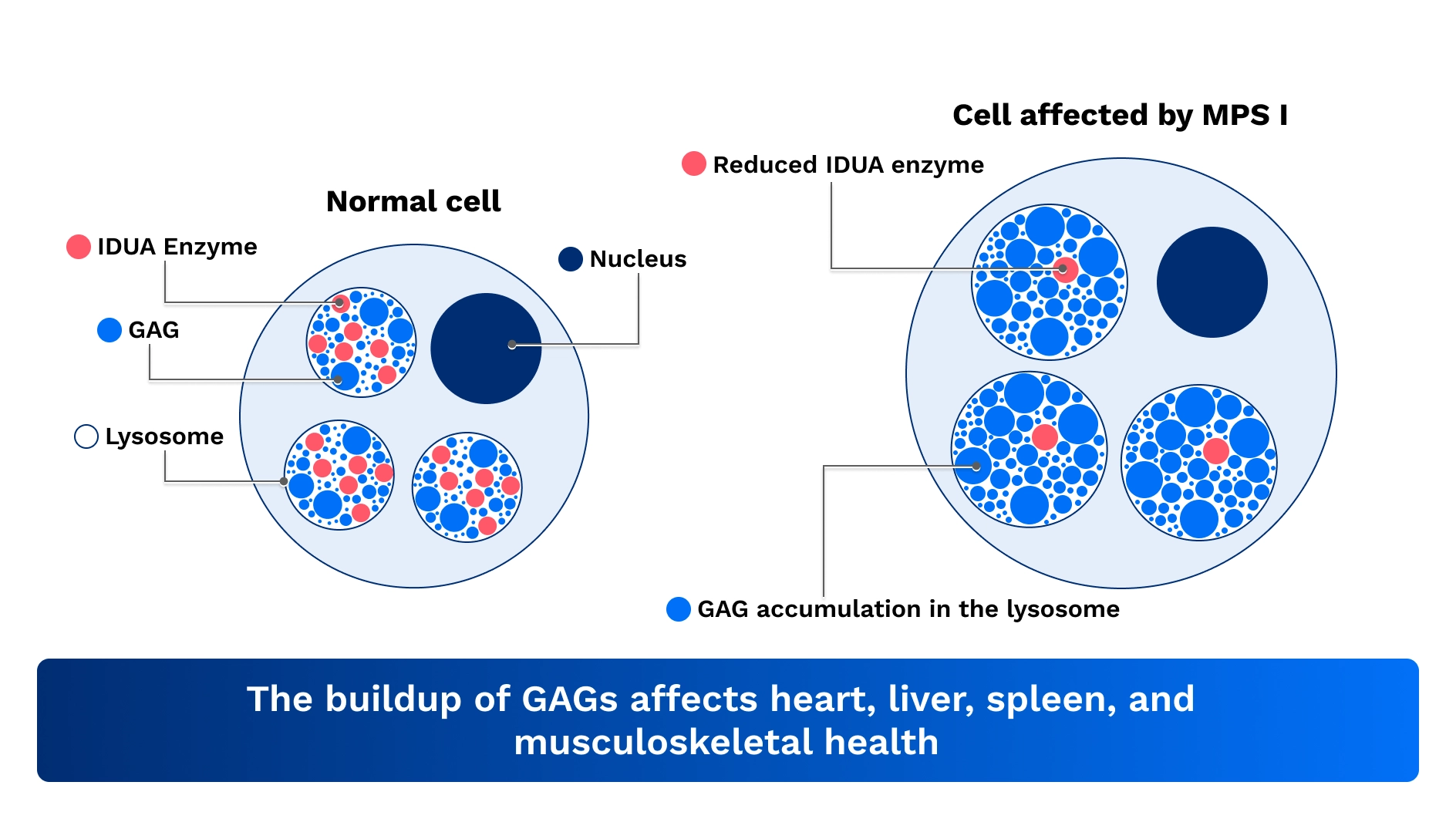 A diagram showing normal cell and cell affected by MPS I