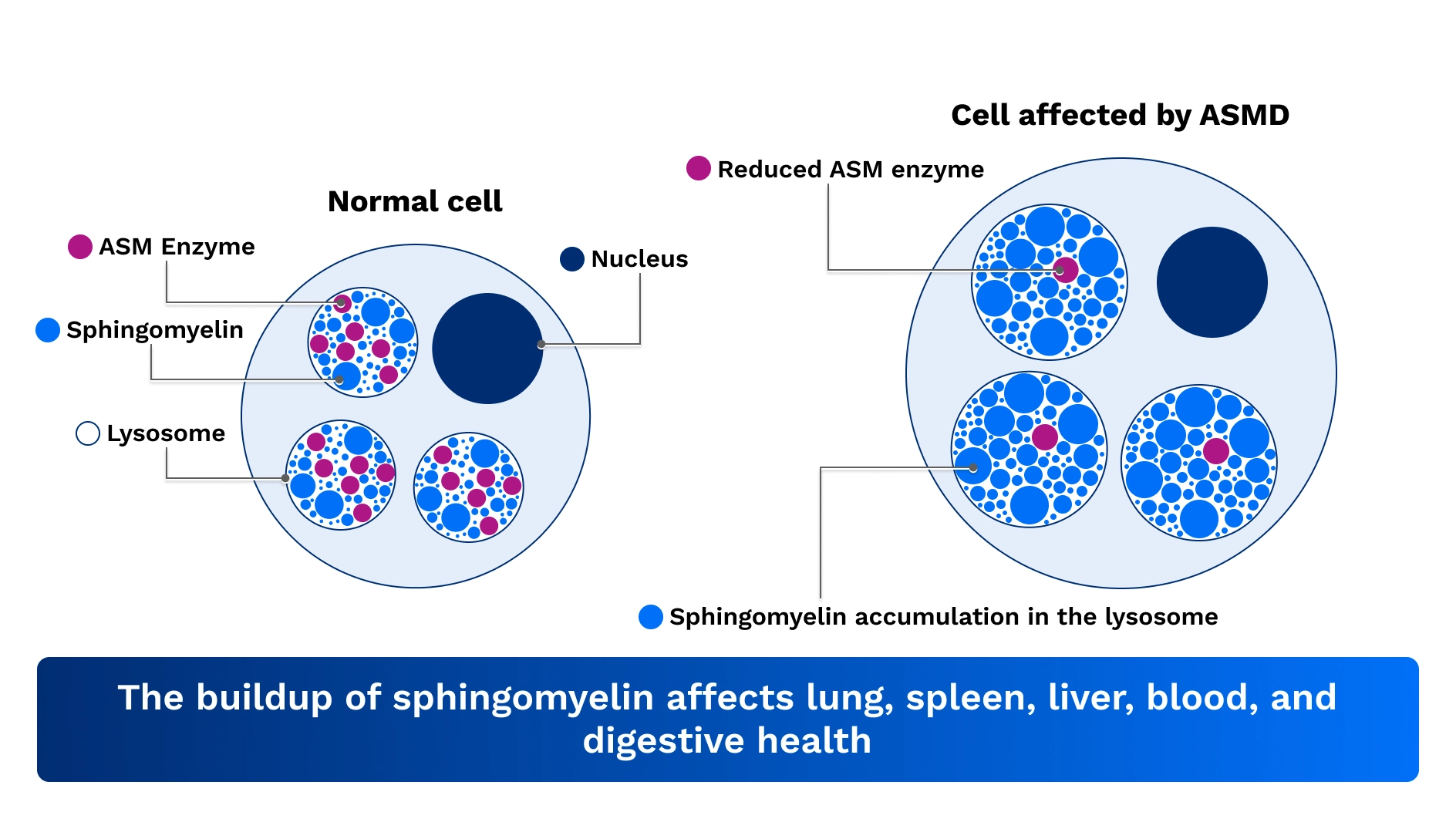 Diagram showing normal cell and cell affected by ASMD; The buildup of sphingomyelin affects lung, spleen, liver, blood, and digestive health